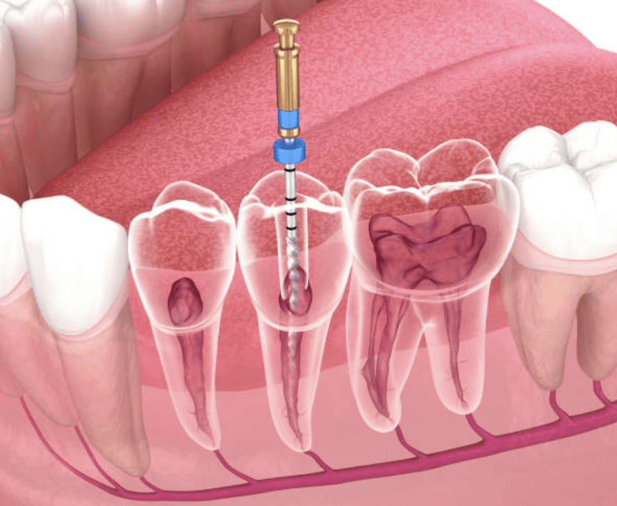 Root Canal Treatment - Absolute Smiles Mount Hawthorn